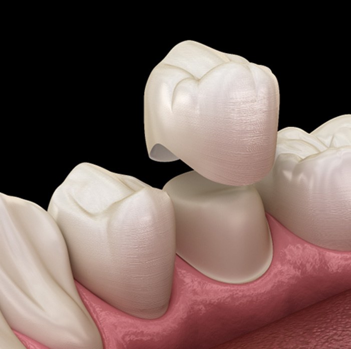 An illustration of dental crowns in Fort Mill