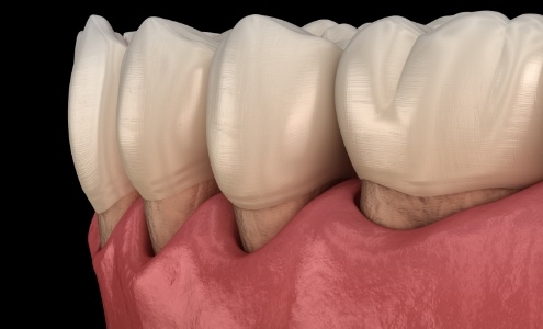 Animated smile with receding gums indicating periodontal disease