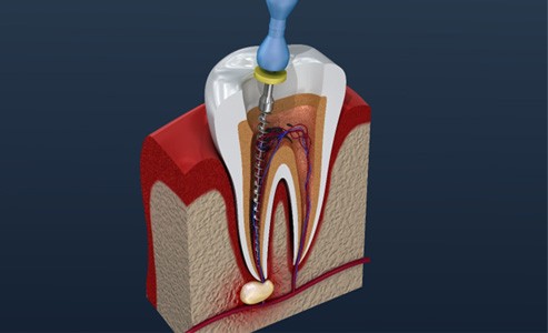 an illustration of root canal therapy in Fort Mill