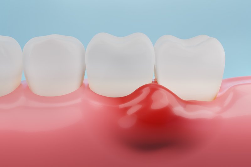 Illustration of dental abscess